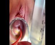 w 4cc inflation of catheter balloon inside cervix from 4cc