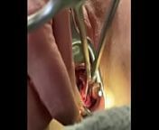 Holding cervix w tenaculum while 8mm dilator fucks uterus from doctor mm