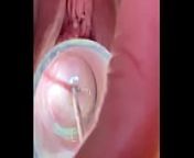 Hegar sound probing deep in cervix from col kink